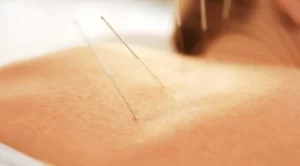 acupuncture